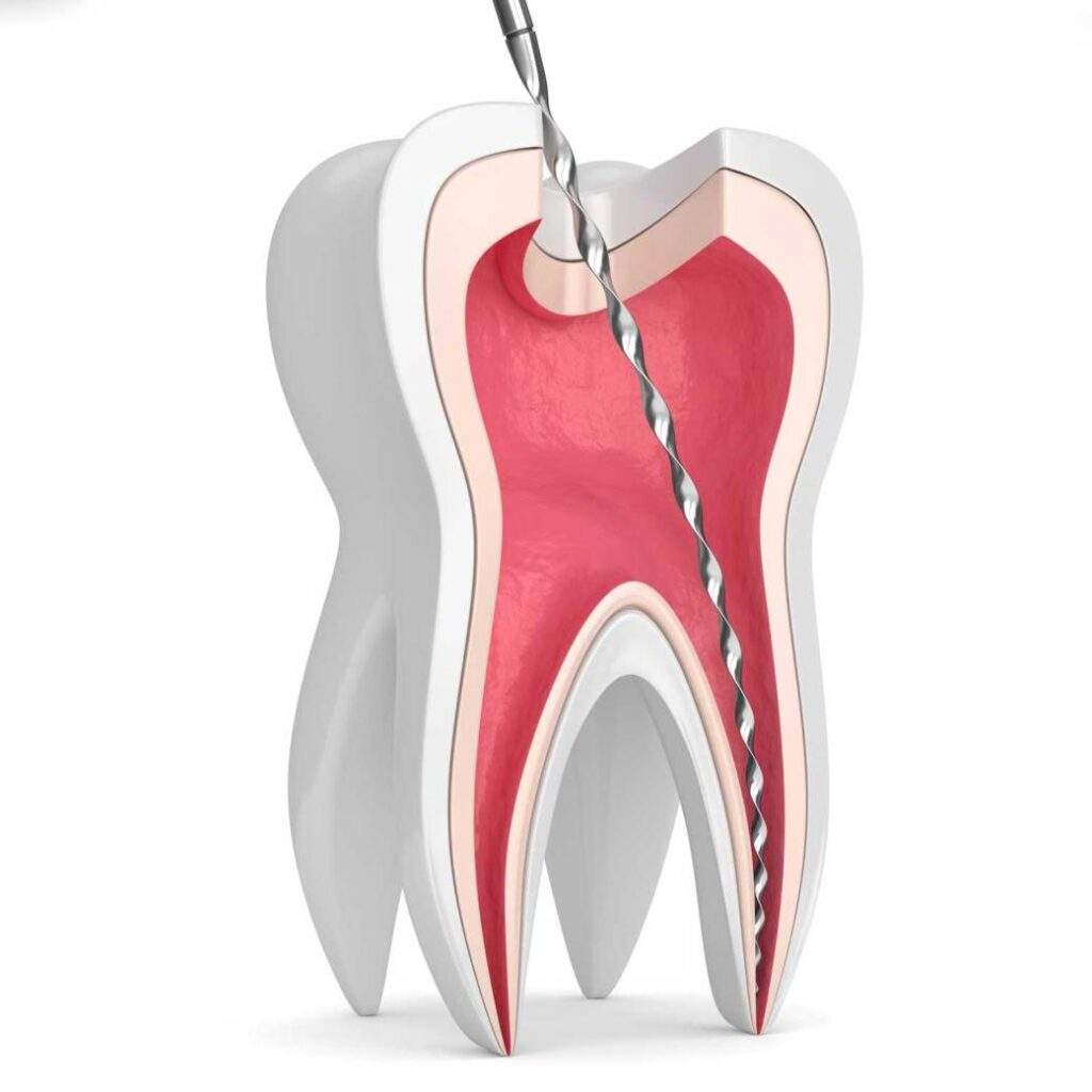 Endodoncia en Puente de Vallecas