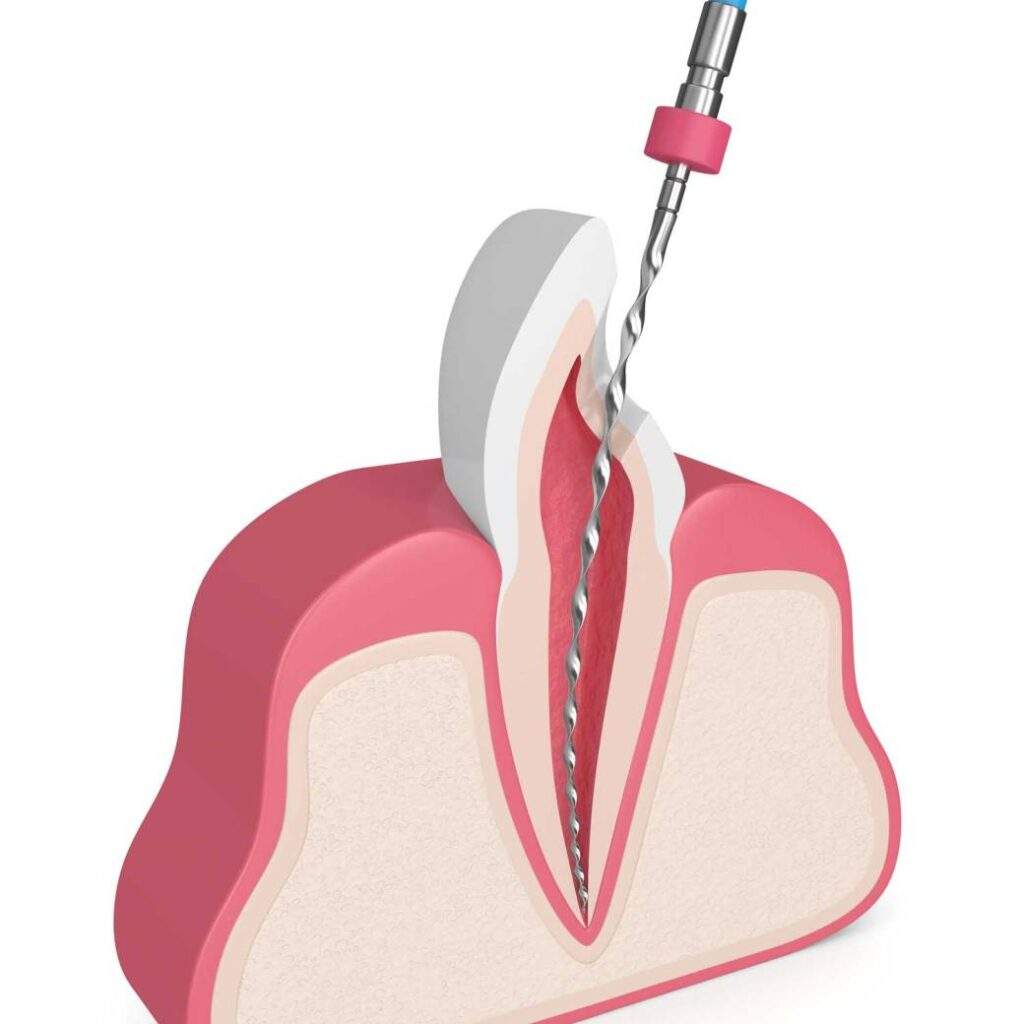 Endodoncia unirradicular en Aluche