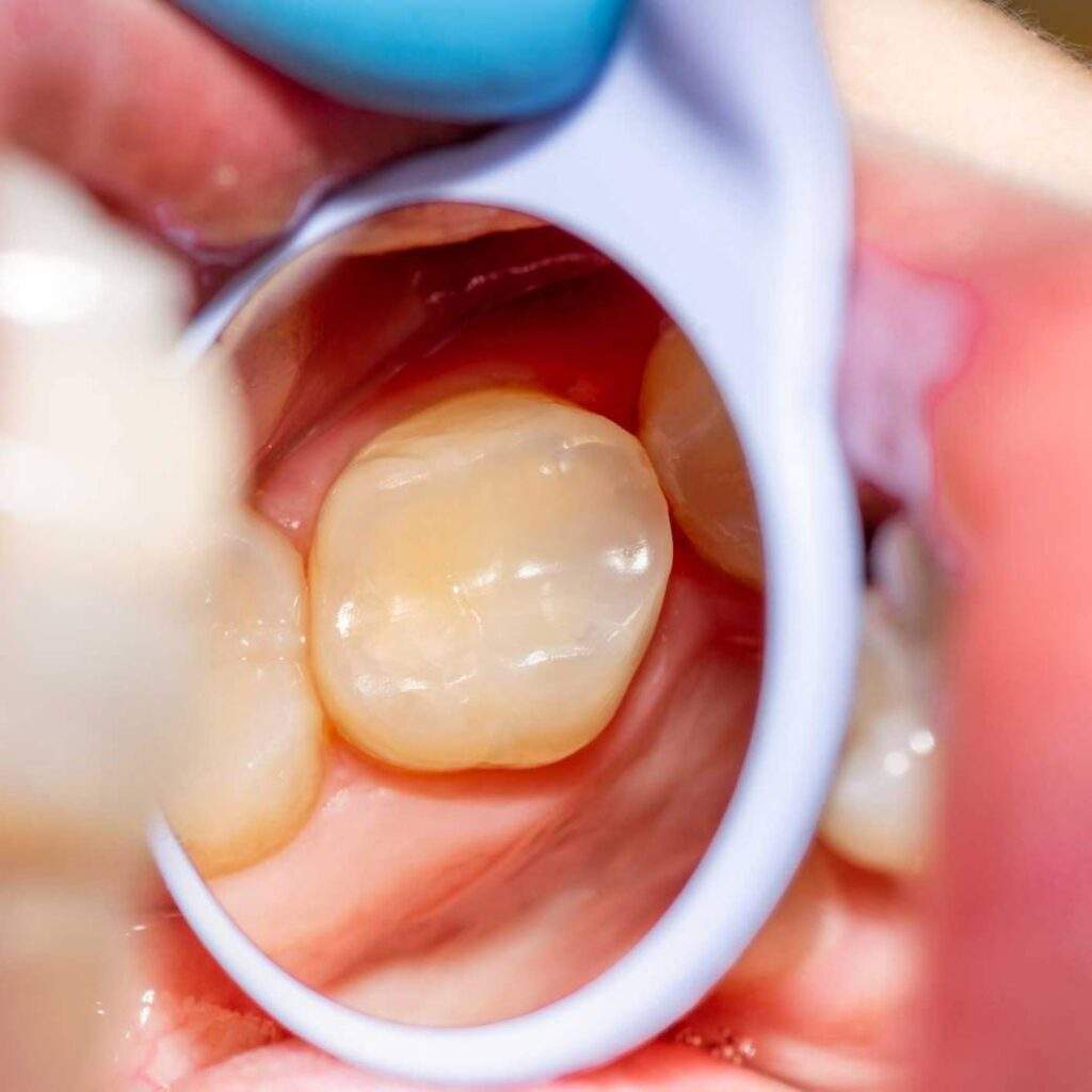 Obturación dental en Hortaleza en un servicio de odontología general