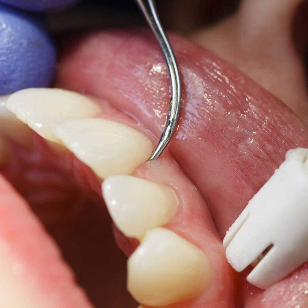 Periodoncia en Aluche