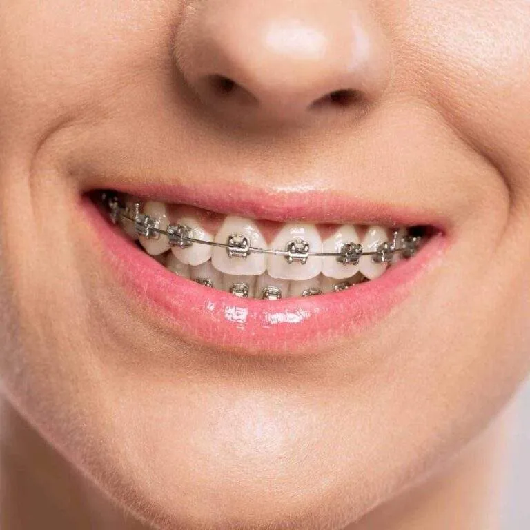 Sonrisa con brackets metálicos