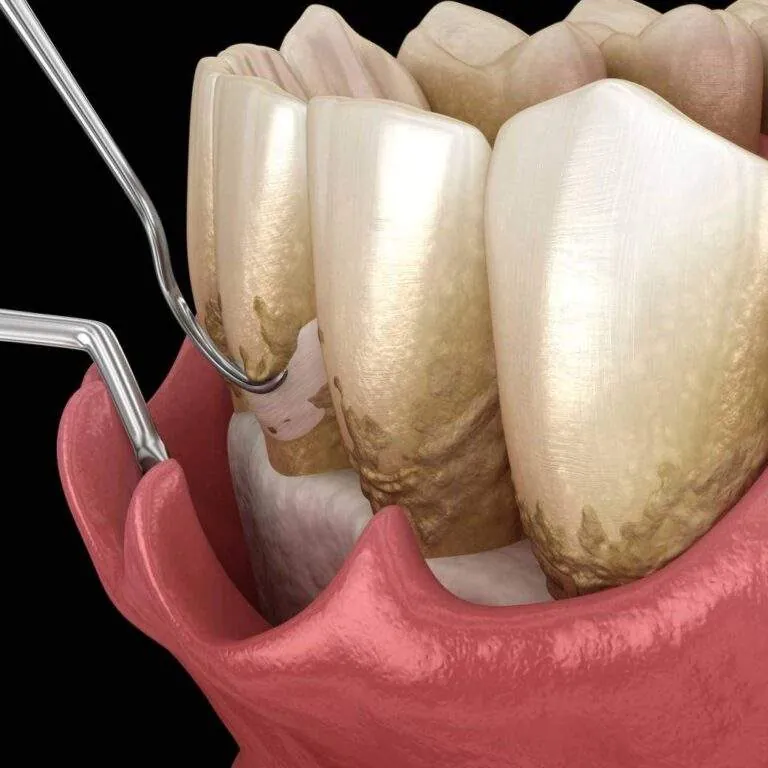 Ilustración de dientes y encías con una sonda periodontal